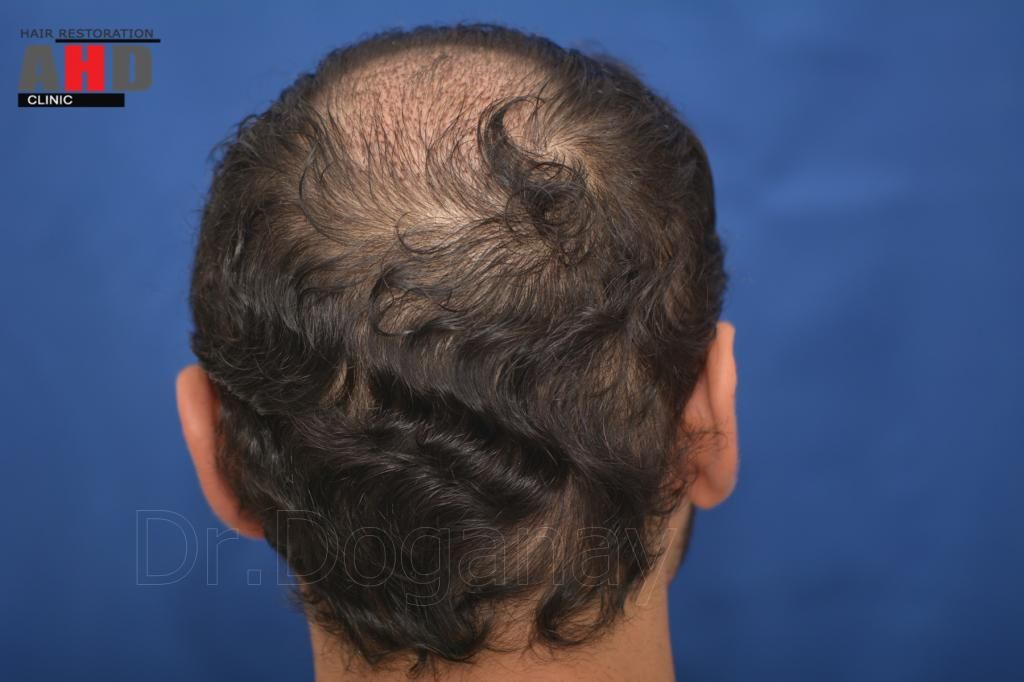 Identical twin hair transplant 16.jpg