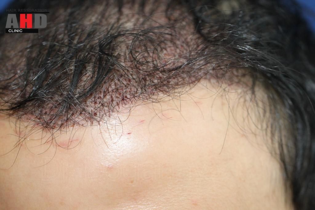 Identical twin hair transplant 17.jpg