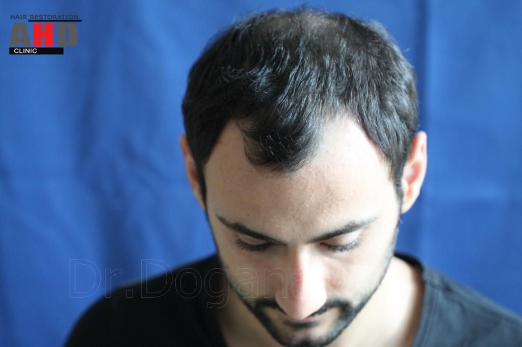 Identical twin hair transplant 18.jpg