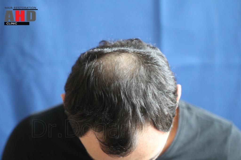 Identical twin hair transplant 19.jpg