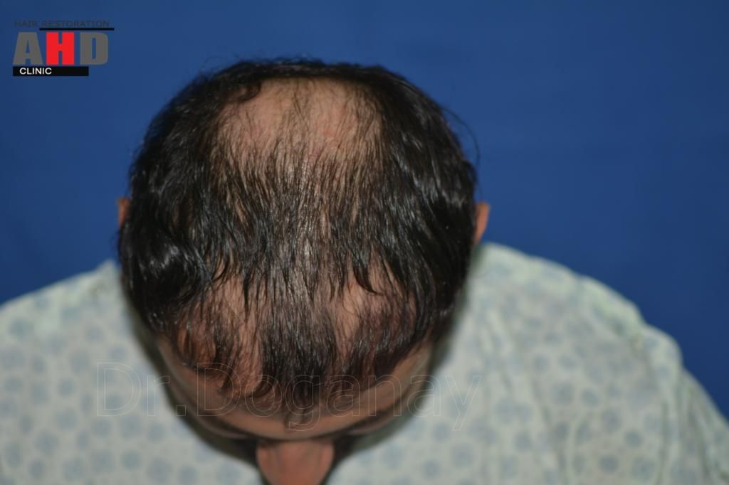identical twin hair transplant 2.jpg