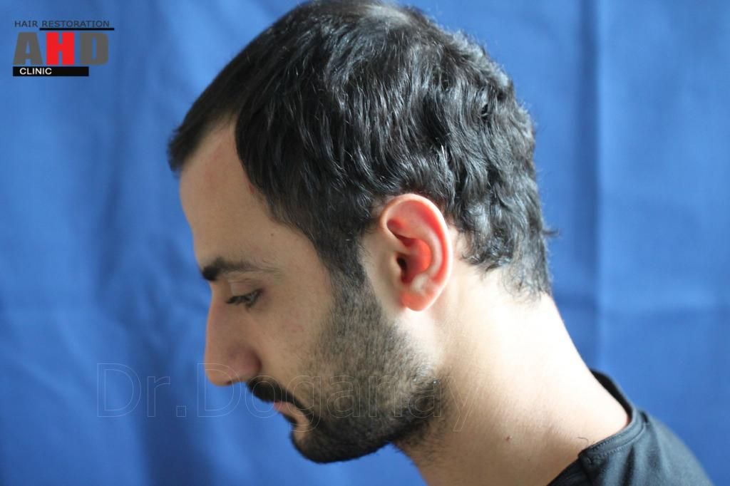 Identical twin hair transplant 20.jpg