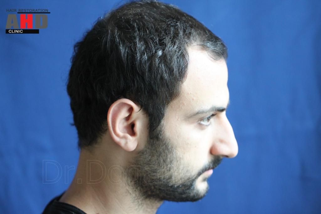 Identical twin hair transplant 21.jpg