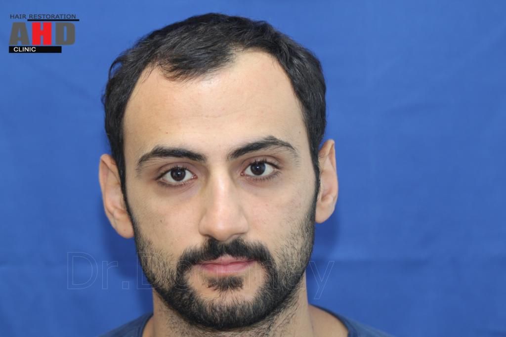 Identical twin hair transplant 22.jpg