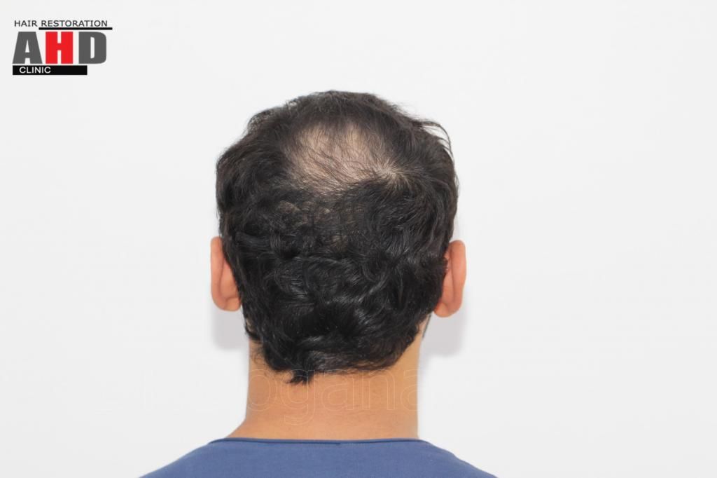 Identical twin hair transplant 23.jpg