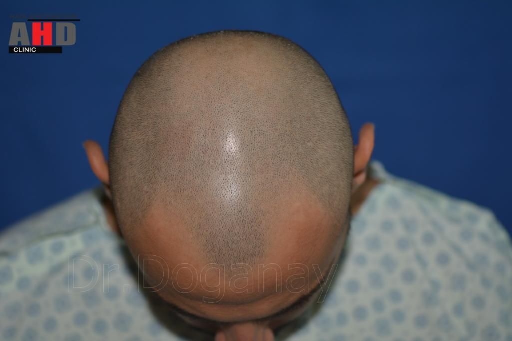 Identical twin hair transplant 25.jpg