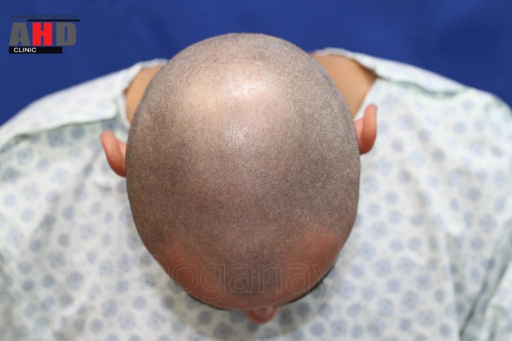 Identical twin hair transplant 26.jpg