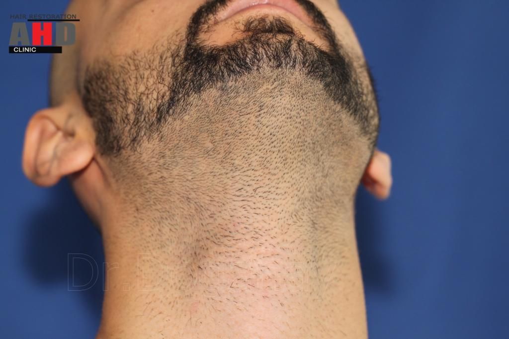 Identical twin hair transplant 27.jpg
