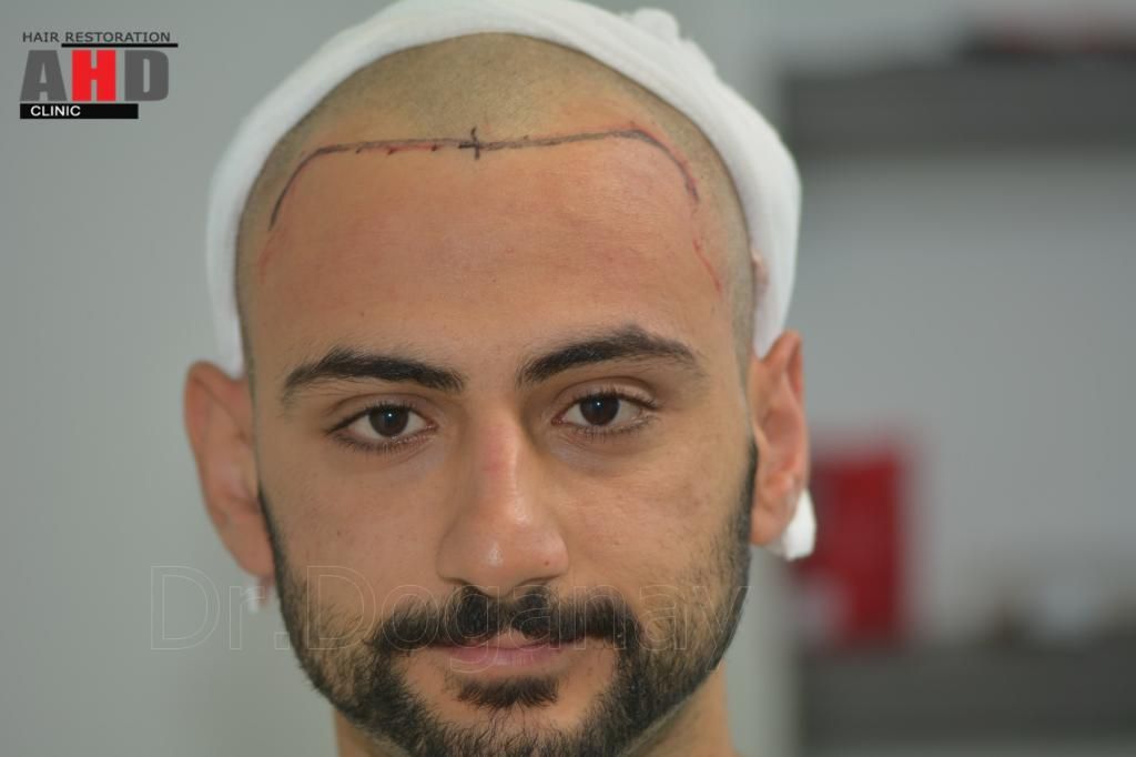 Identical twin hair transplant 28.jpg