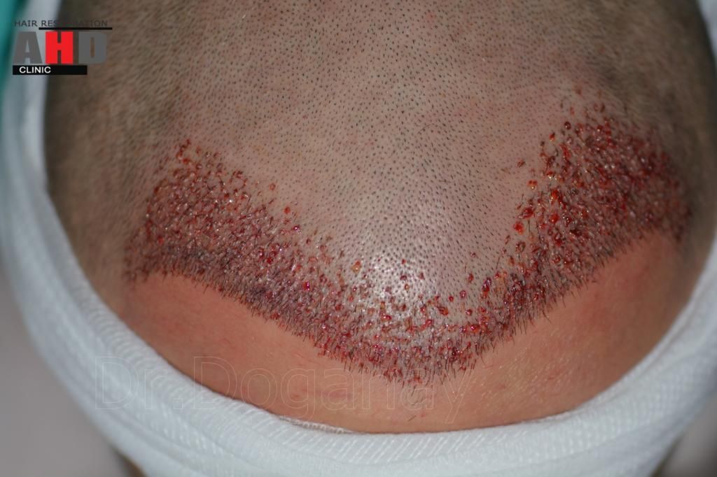 Identical twin hair transplant 29.jpg