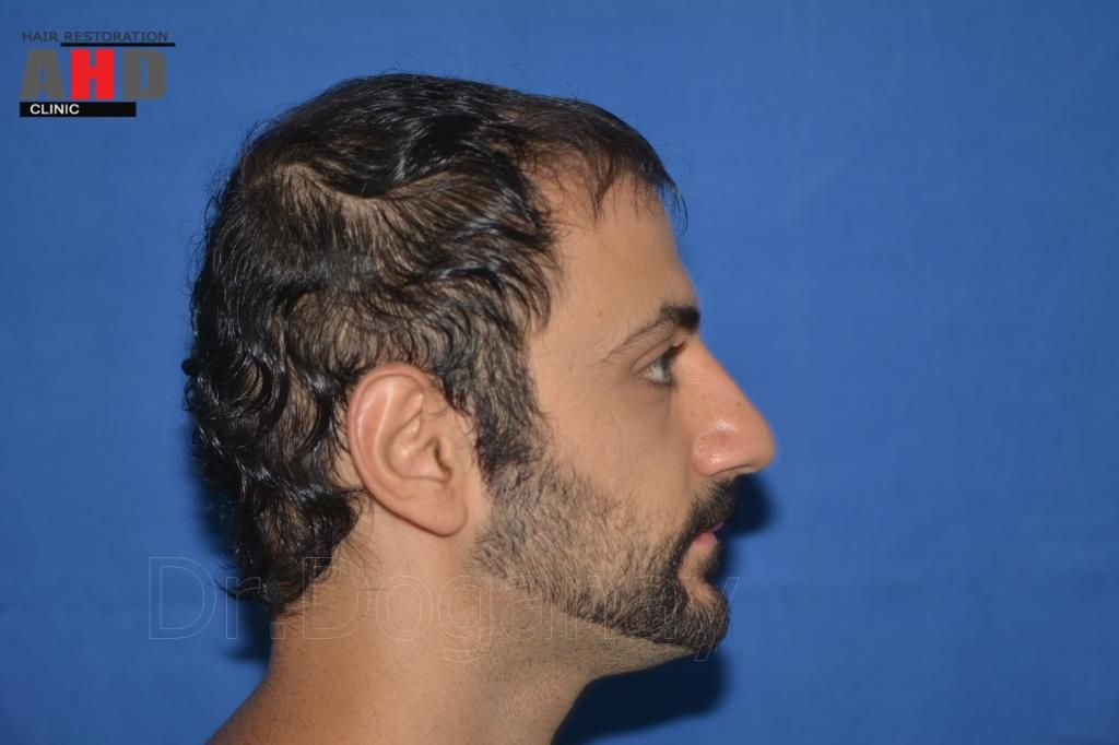 identical twin hair transplant 3.jpg