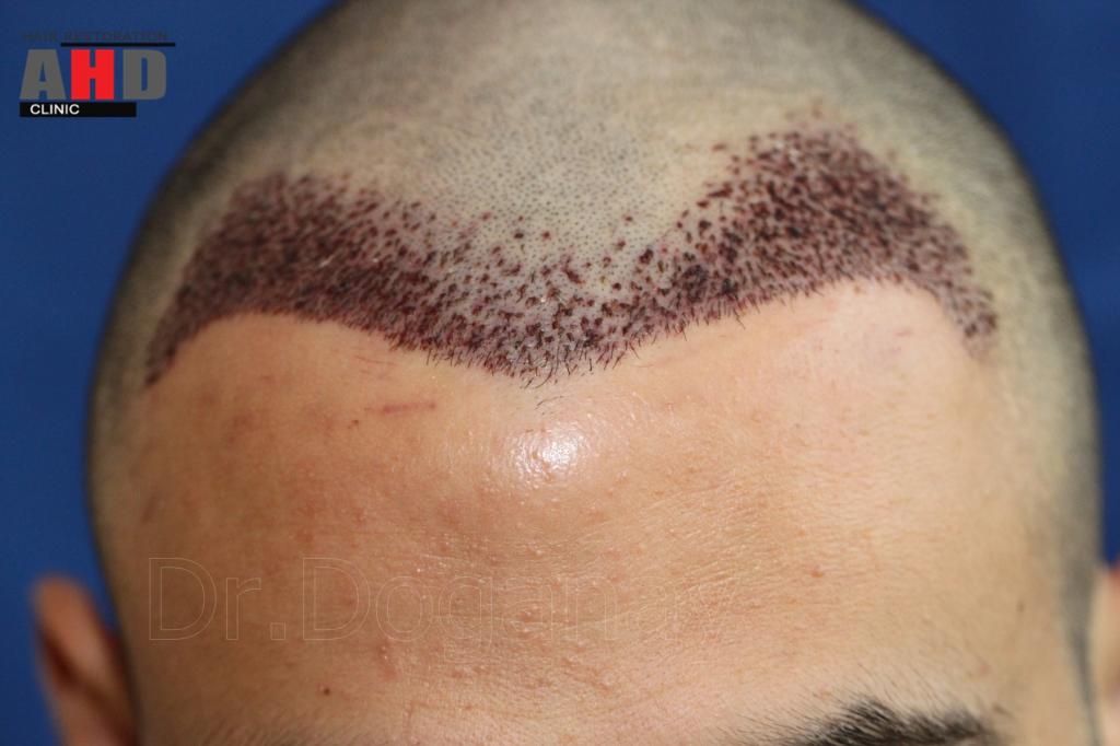 Identical twin hair transplant 31.jpg