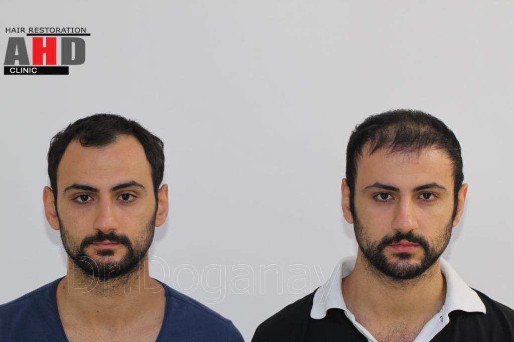 Identical twin hair transplant 32.jpg