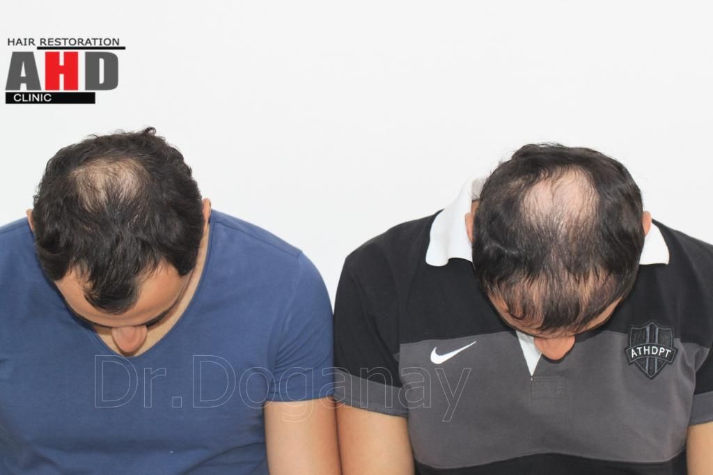Identical twin hair transplant 33.jpg