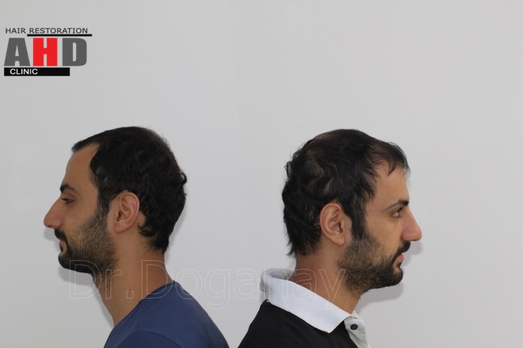 Identical twin hair transplant 34.jpg