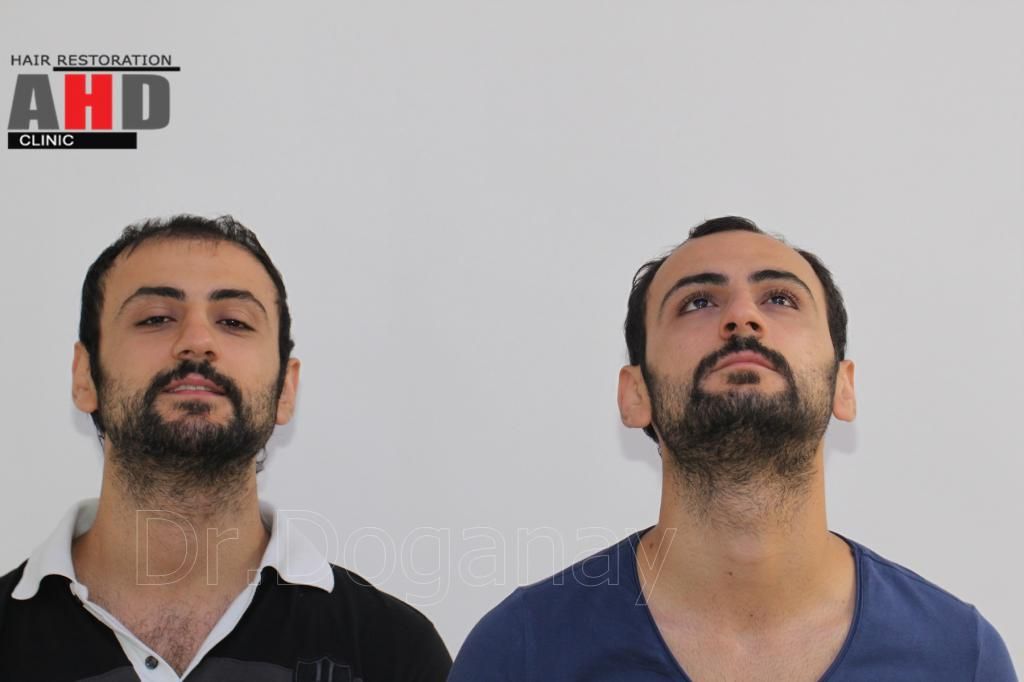 Identical twin hair transplant 35.jpg