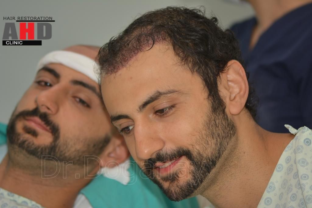 Identical twin hair transplant 36.jpg