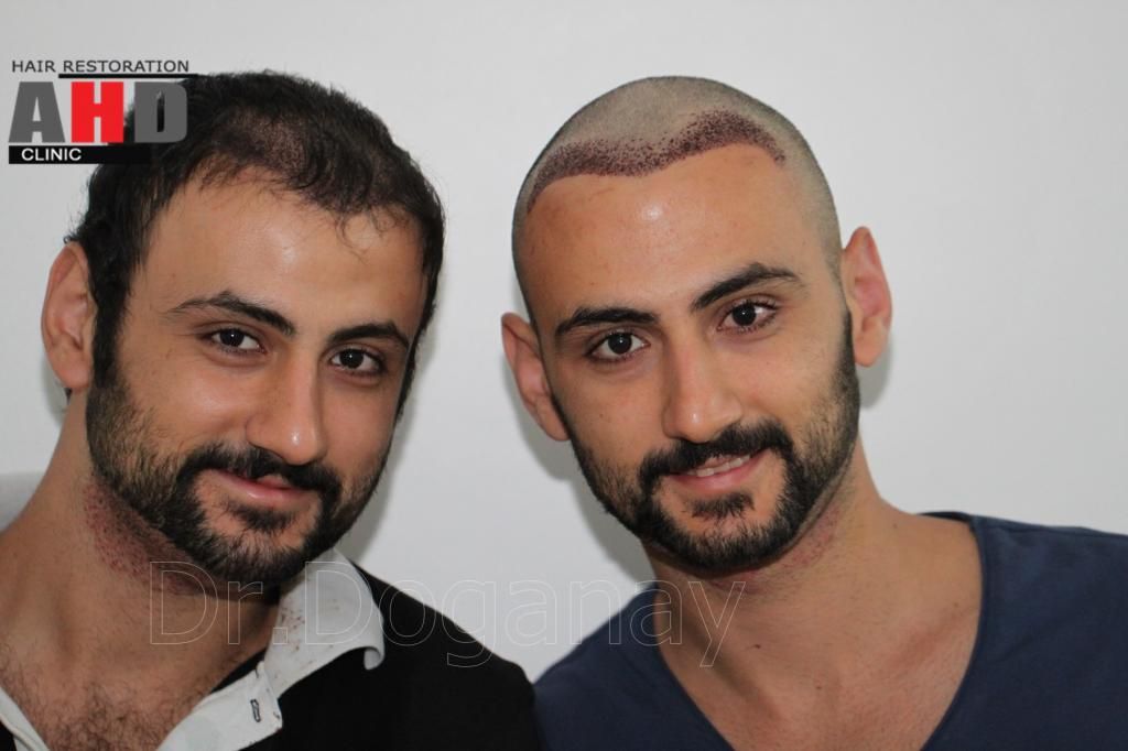 Identical twin hair transplant 38.jpg
