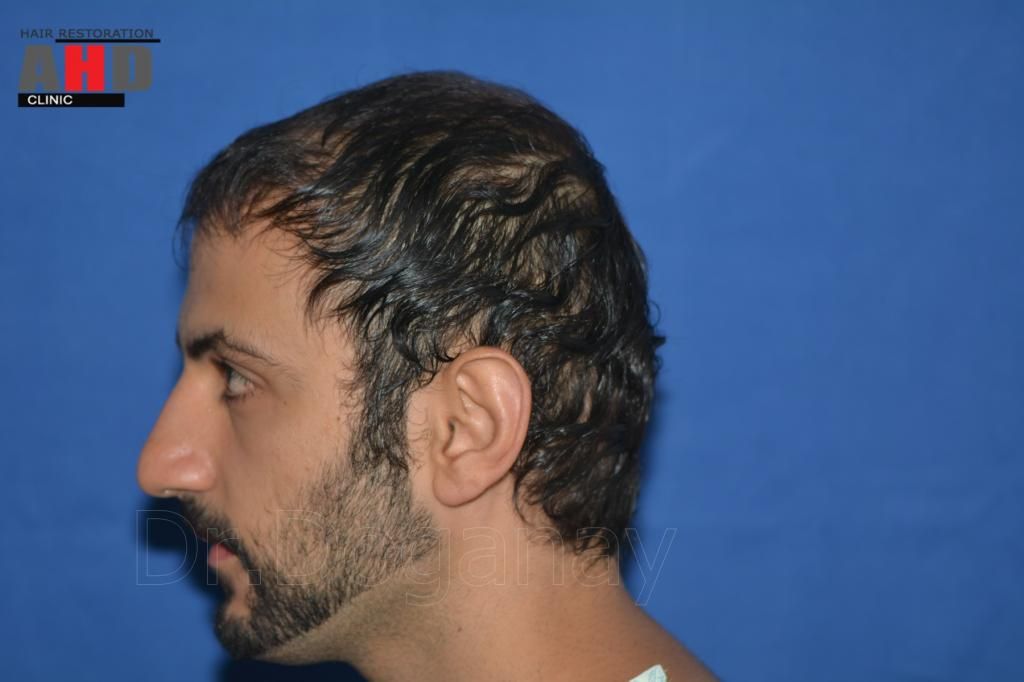 identical twin hair transplant 4.jpg