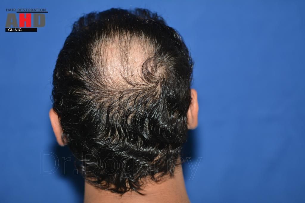 identical twin hair transplant 5.jpg