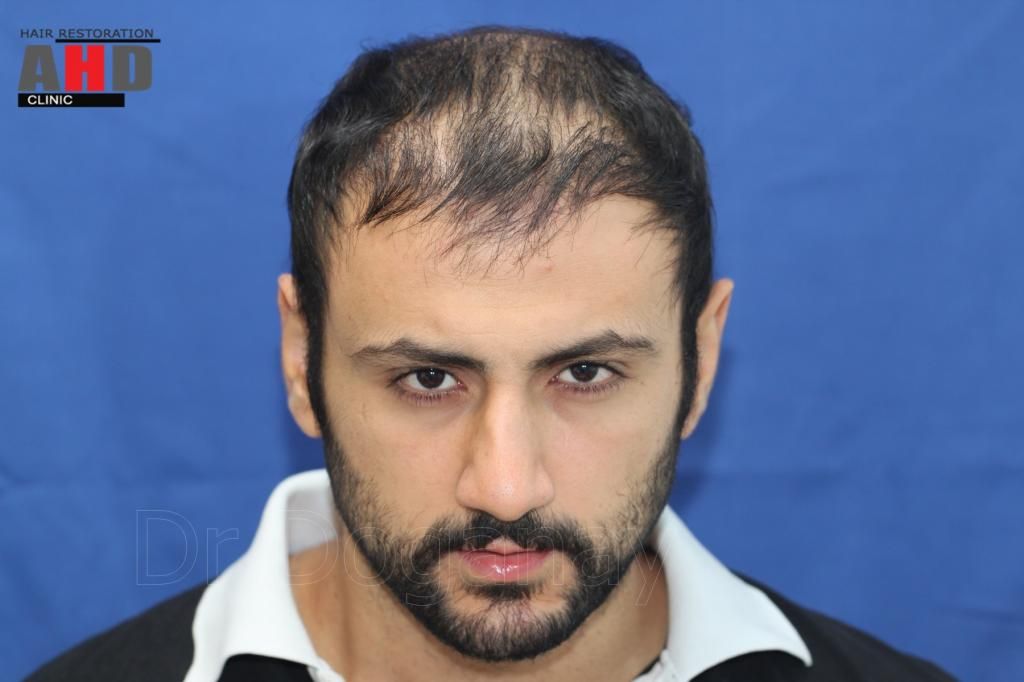 identical twin hair transplant 6.jpg
