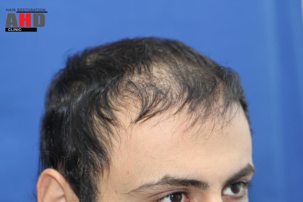 identical twin hair transplant 7.jpg