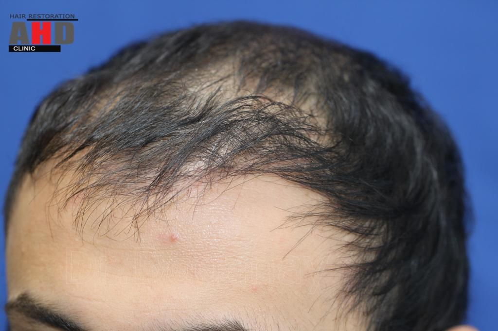 Identical twin hair transplant 8.jpg