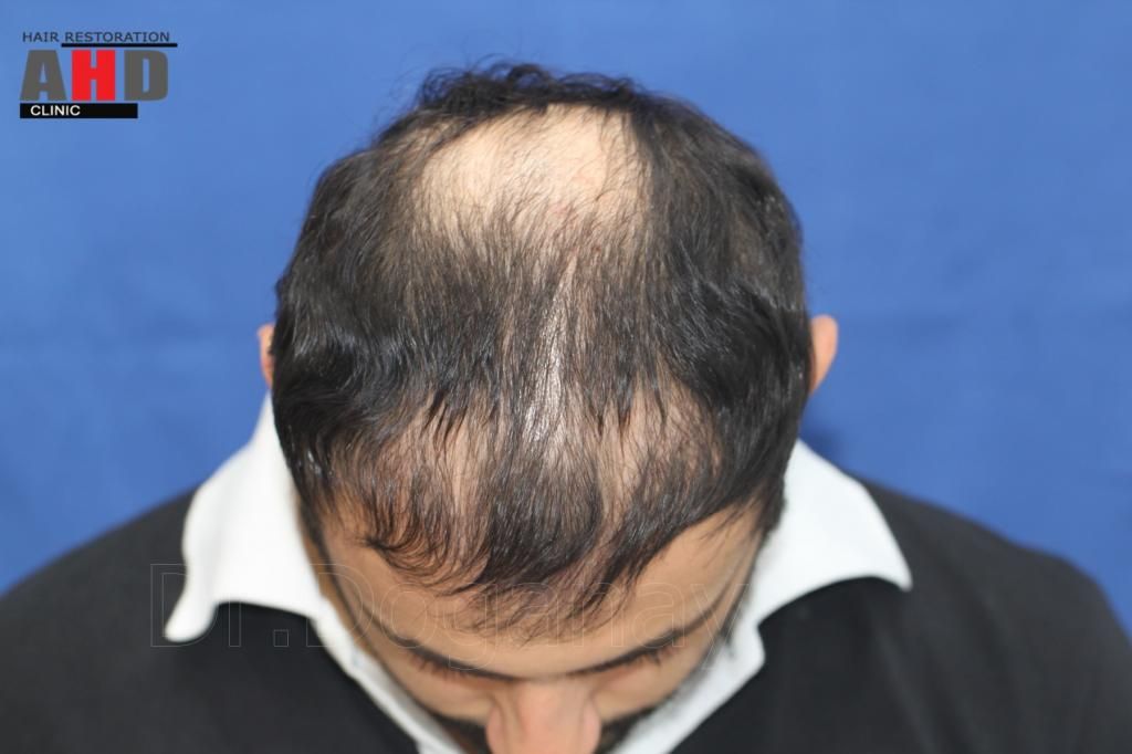Identical twin hair transplant 9.jpg