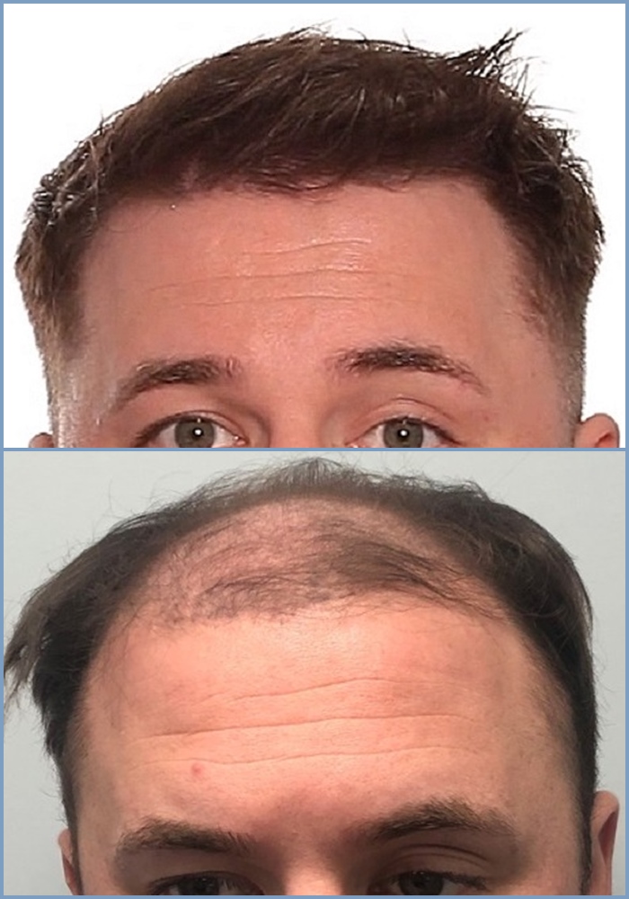 j-before-after-hairline-dr-nikos-hair-transplant-result.jpg
