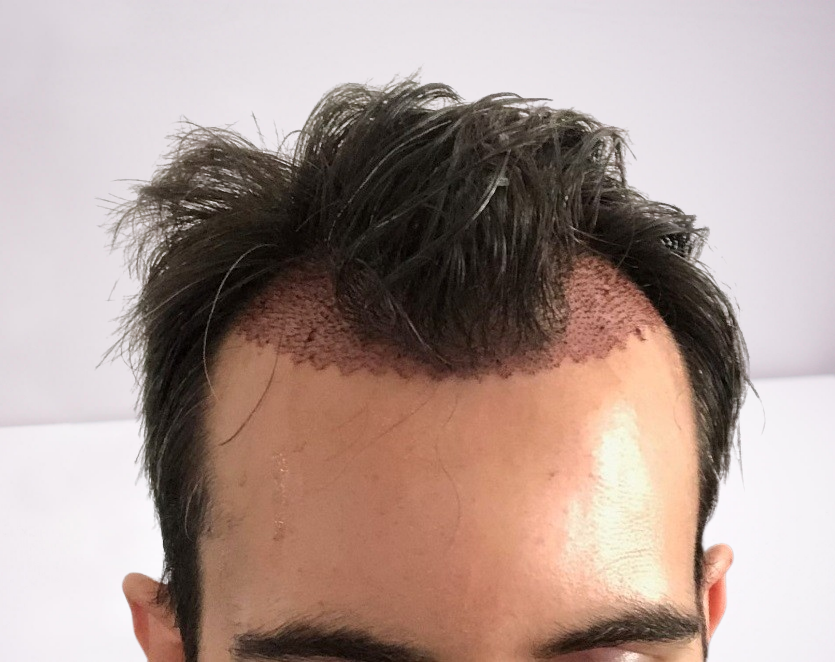 post-op-dr-nikos-removebg.png