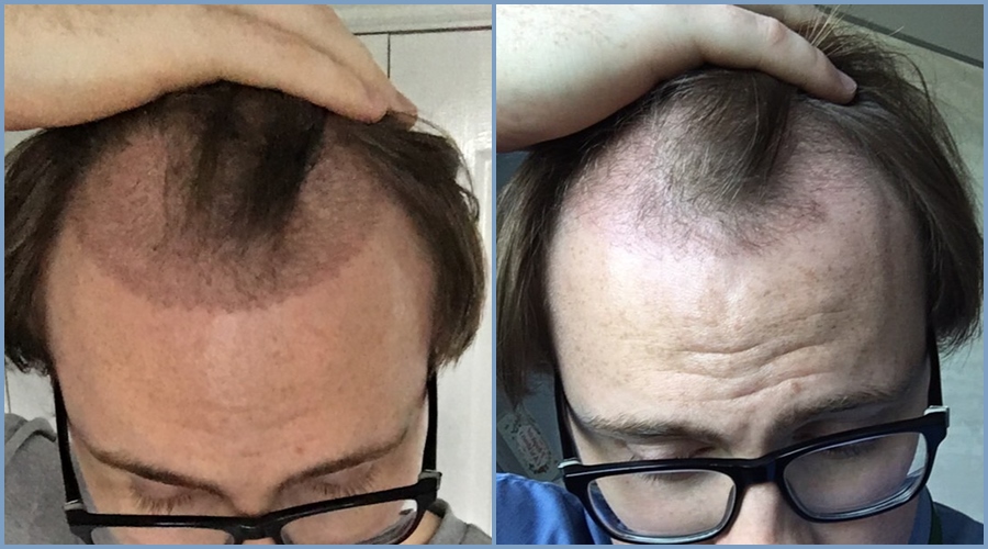 post-op-healing-dr-nikos-hair-transplant.jpg